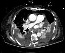 planned mas ACS+ZDOM 50 0-200 -300-400 Slice position (mm) -500-600 Ursache: Arme beim Übersichtsradiogramm unten (Planung für Hals/Thorax/Abdomen) Arme bei