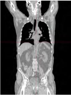 al: IEEE NSS-MIC, 2007, M18-182:3436-39 Aktuelle PET/CT Systeme: