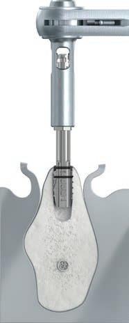 Den Gewindeschneider maximal bis zur Oberkante des schneidenden Arbeitsteiles eindrehen, für 7,3 mm lange Implantate nur bis zur ersten Markierung.