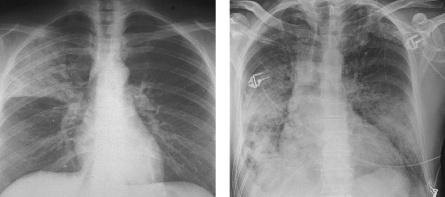 2 Thorax des Intensivpatienten a b Abb. 2.49 a c Verschiedene Verschattungsmuster einer Pneumonie. a Homogene Lappenpneumonie mit Luftbronchogramm (Lobärpneumonie).