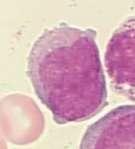 Ab 20% Blasten wird aus einer Myelodysplasie eine akute myeloische Leukämie.