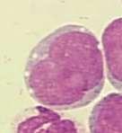 Classification of neoplastic diseases of the hematopoietic and lymphoid tissues: Report