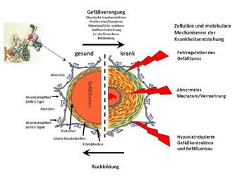 The blood passes through the substance of the lung Abb. 2: Schematische Darstellung der pathologischen Vorgänge beim Gefäßumbau in der Lunge.