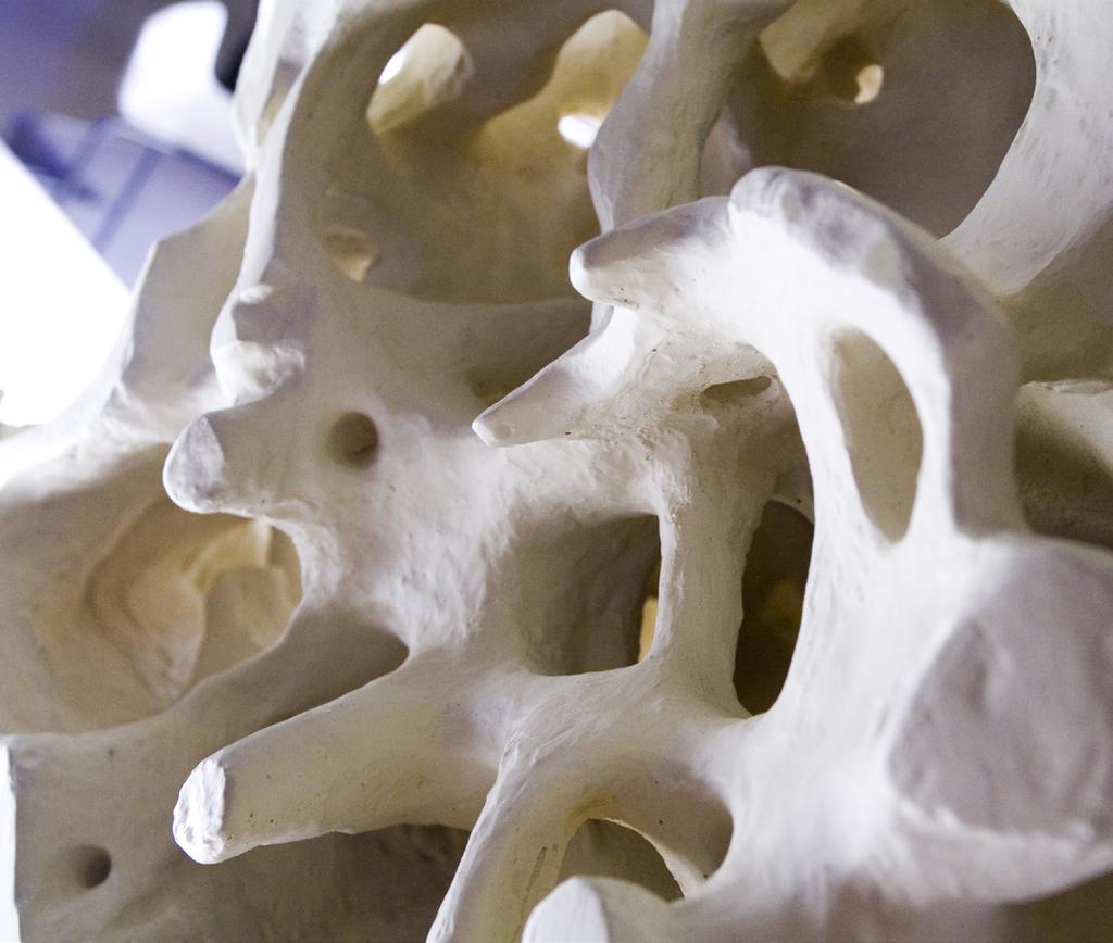 normaler Knochen osteoporotischer Knochen WAS IST OSTEOPOROSE?