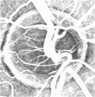 Material und Methoden a b Abbildung 9: a Die Kapillarstruktur in der Frühphase der Fluoreszein-Angiographie eines Probanden mit großer physiologischer Exkavation bei Makropapille, Kapillarnetz