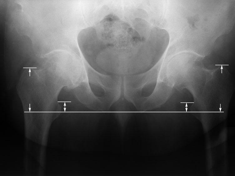 Präoperative Planung Ermittlung einer möglichen Beinlängendifferenz Mittels klinischer und röntgenologischer Untersuchung die präoperative Beinlängendiskrepanz bestimmen.