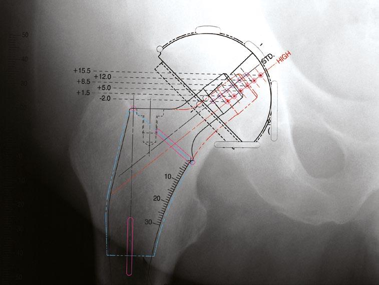 Femurschaftauswahl Mit dem knochenerhaltenden TRI-LOCK BPS-Schaft wird proximal an den medialen und lateralen endostalen Kortizes ein enger kortikaler Kontakt erzielt.