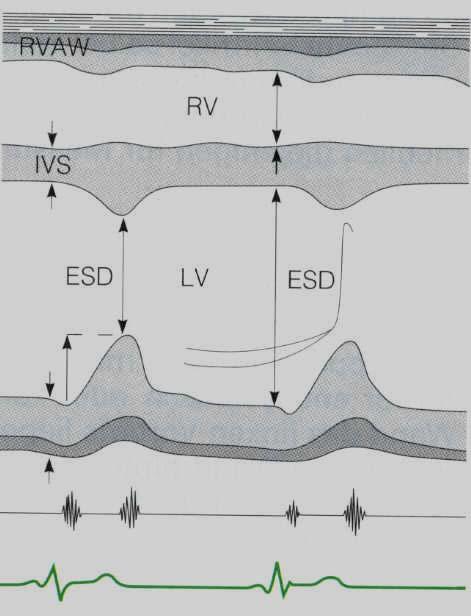 Messung I b parasternale lange Achse: Aorta, Klappen Separation Mitralklappe