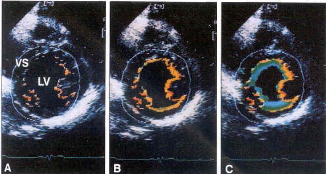 Segmentalis kontraktilis functio echocardiographiás vizsgálata Color kinesis Bal kamrai endocardium mozgásának