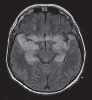 542 Übersicht Abb. 3 HSV-1-Encephalitis. 66-jährige Patientin mit rezidivierenden generalisierten Krampfanfällen.