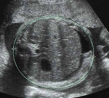 4 Formen des Hydrops fetalis Die Flüssigkeitsansammlung im Körper des Feten bzw. des Neugeborenen kann verschiedenste Areale betreffen und ist laut Studien teilweise von der Ätiologie des HF abhängig.