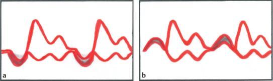 Dorsalbewegung der Mitralsegel in der Systole bei Mitralklappenprolaps (Abb. 1.25a). Anteriore Bewegung der Mitralsegel in der Systole (systolic anterior movement = SAM) bei HOCM (Abb. 1.25b).