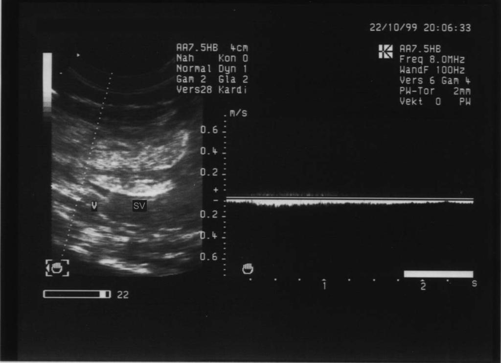 Zunächst wurde bei rechtsseitiger Schallkopfposition (9 Uhr-Position) der Eintritt der kaudalen Hohlvene in den Sinus venosus dargestellt.