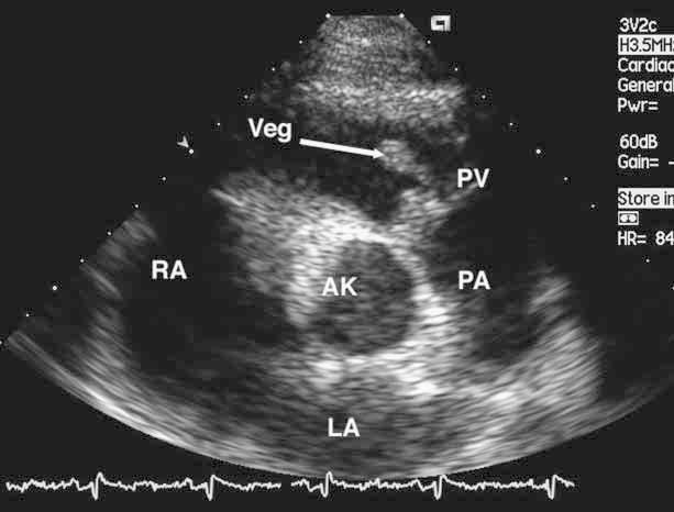 Rubrik: Echo Abbildung 4: Kurze Achse in Höhe der Herzbasis: Von der Pulmonalklappe (PV) ausgehend, finden sich mehrere große Strukturen, Vegetationen (Veg), welche in den rechtsventrikulären