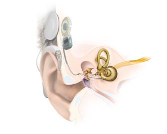 Was ist ein Hörimplantat? Selbst mit einem hochgradigen Hörverlust kann man heute dank modernster Technik hören.