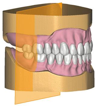 2 4 Vorteile des digitalen Prozesses: hohe Genauigkeit der Modellanalyse reproduzierbare, systematische Aufstellung der Zähne ideale Okklusionsbeziehung, Kontaktpunkte nach Zahnherstellervorgabe