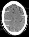 Anatomie des Kopfes 2 3 Falx cerebri Lobus parietalis praecentralis Sulcus centralis postcentralis Sinus sagittalis Falx