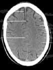 Lobulus parietalis inferior Sulcus intraparietalis 6 7 frontalis frontalis medialis Lobus parietalis Lobus occipitalis 8