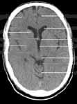 sagittalis Insula Thalamus Sulcus temporalis 11 cornu frontale Capsula externa Capsula