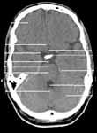 cerebri media Cisterna ambiens Calliculus frontalis inferior Sulcus lateralis Infundibulum
