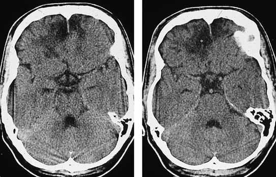 2TraumatischeVeränderungen Kontusionsherde Häufigkeit: Bei Patienten mit Kopfverletzungen häufiger CT-Befund.