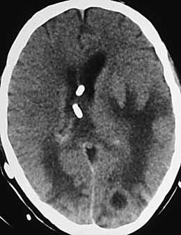 b Bei klinisch gesicherter Meningitis erkennt man in der nativen CT beidseits kortikale Hypodensitäten, die sekundär vaskulitischen Infarzierungen entsprechen.