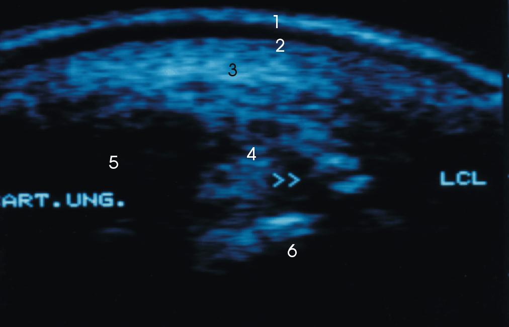 Pfeile: Avulsionsfraktur des Ligamentum collaterale laterale/noduli Abb.