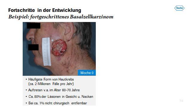 Ansprache Severin Schwan Seite 13/17 Das Basalzellkarzinom ist in Europa, den USA und Australien die häufigste Form von Hautkrebs.