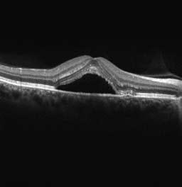 Forschungsergebnisse fließen hier direkt in Behandlungsmethoden ein. Blick auf die Makula Optischer Schnitt durch die Makula in der Region des Pfeils.