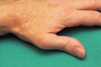Die Krankheit 7 Mit der Zeit mehren sich die Entzündungen vieler kleiner und grosser Gelenke. Am häufigsten befallen sind die Finger- und Handgelenke, oft in symmetrischer Anordnung.