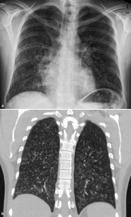 32 Übersicht Tab. 2 Klassifikation der bronchiolären Erkrankungen nach der Beteiligung des Interstitiums und der Assoziation mit anderen Erkrankungen (mod. nach [2]).