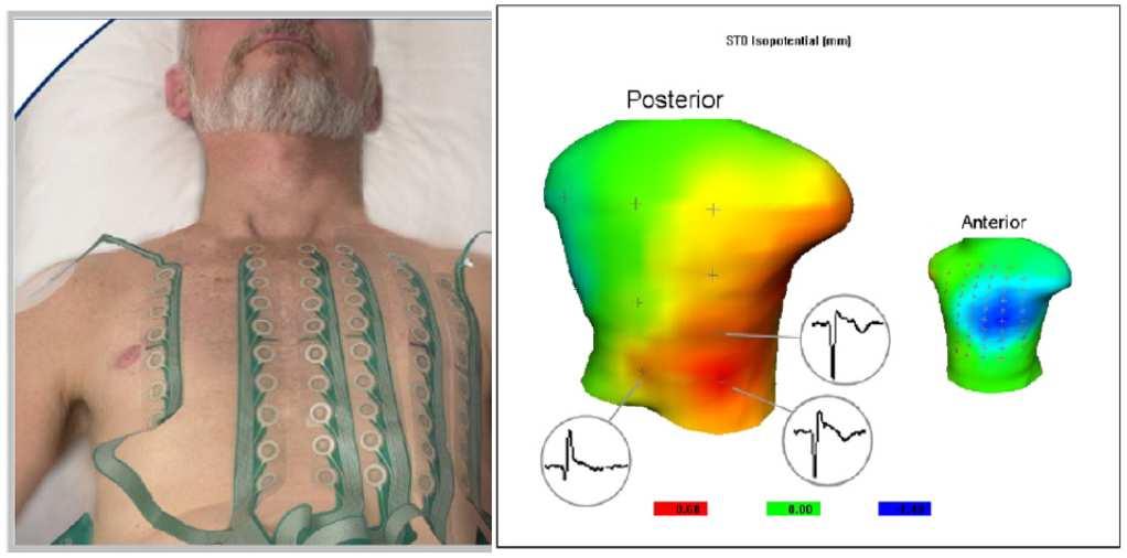 Zukünftige EKG Optionen beim Infarkt Zusätzliche Elektroden 16-Elektroden: V3R, V4R, V8, V9 80-Elektroden: EKG-Weste Identifikation von ST-Hebungen bei zusätzlich 10% der aktuellen