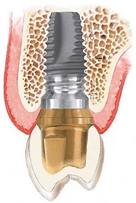 Implantate - Wie funktioniert das eigentlich? Zahnimplantate werden in den Kiefer eingepflanzt und wachsen im Knochen fest. Dieser Vorgang wird als Osseointegration bezeichnet.