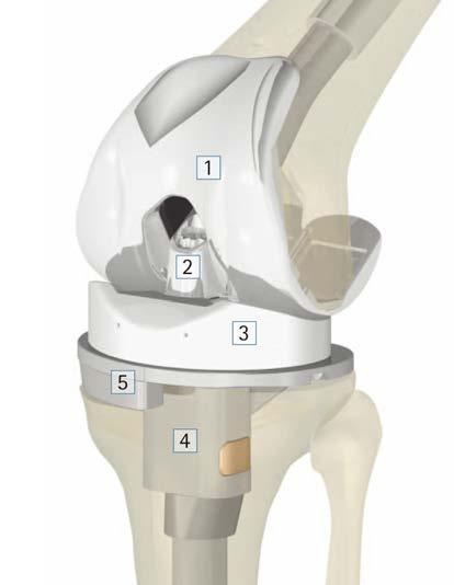 Das achsgeführte Gelenk Sind durch die entzündlichen Prozesse der Arthrose oder aber auch durch frühere Unfälle Seitenbänder des Kniegelenk funktionslos, sollte