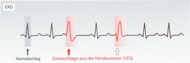 Das spricht for zwei verschiedene Ursprungsorte (vergleiche monomorphe VES) langt der Strom ungebremst zur Herzkammer Proarrhythmie unerwiinschter Effekt von Medikamenten gegen Herzrhythmusstorungen: