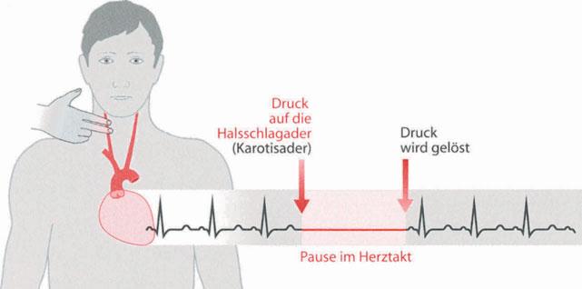 Kalium, ein Zustand der HerzrhythmusstOrungen begunstigt Hypokinesie Minderbeweglichkeit eines Teils des Herzmuskels oder einer Herzklappe Hysterese spezielle Funktion eines Herzschrittmachers: Nach