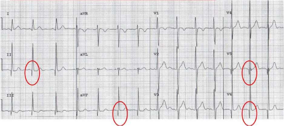 Abnormale Diagnosis EKG of AMI: Veränderungen