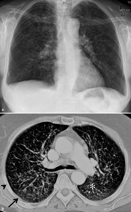 (b) Der Transversalschnitt zeigt bizarr geformte Zysten in den Unterlappen bds. Dazwischen ist die Lunge mit dünnwandigen Zysten durchsetzt.