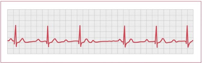 Bis zu 50 % der Patienten mit DDD Schrittmacher-Implantation haben eine SBAS.