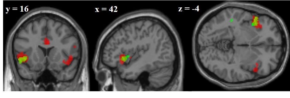 Ergebnisse fmrt-studie Zum Vergleich von Gehirnregionen, die sowohl bei der motorischen Antwortinhibition als auch bei der Antwortselektion in Abhängigkeit von der Perspektive rekrutiert werden,