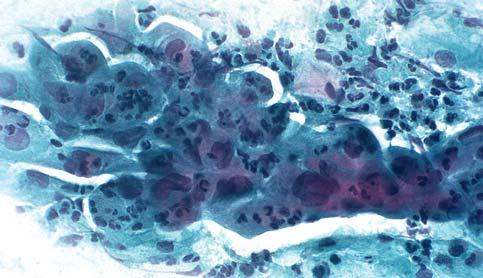 Es können sowohl größere Zellen mit breitem Zytoplasmasaum als auch kleinzellige Varianten mit schmalem Zytoplasma vorkommen, so dass bei der schweren Dysplasie immer die Gefahr besteht, sie zu