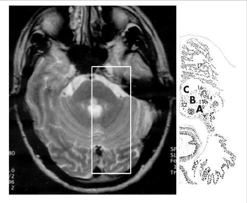 Hypersomnie Neurologisch Schlafmedizinische Narkolepsie Fortbildung, 16.5.