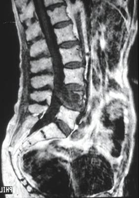 Die dorsale Stabilisierung der BWS war aufgrund einer fortgeschrittenen Zerstörung auch dorsaler Wirbelsäulenabschnitte notwendig geworden Eine 36-jährige Patientin stellte sich mit