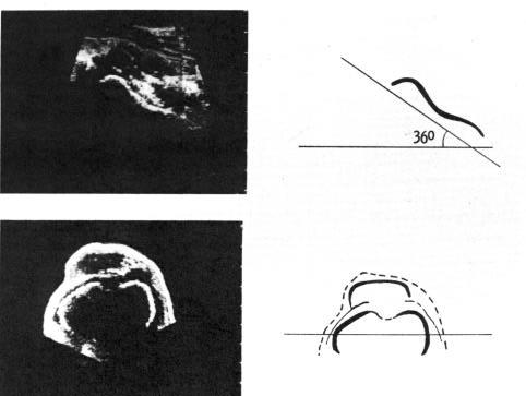 1.2.4 Ultraschallbasierte Verfahren Moulton und Upadhyay veröffentlichten 1982 erstmals eine auf Ultraschall basierende Methode zur Bestimmung des ATW.