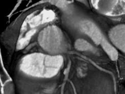 Gefäßbildgebung / Angiographie MSCT Degree of stenosis