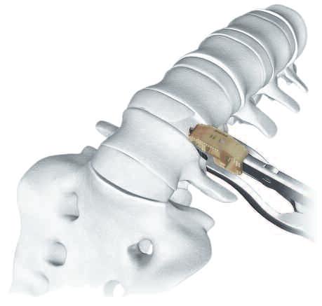 Schritt 10 Implantat einführen Wenn das SynCage-LR 45 /90 Implantat zum Einführen vorbereitet ist, das Segment erneut distrahieren.
