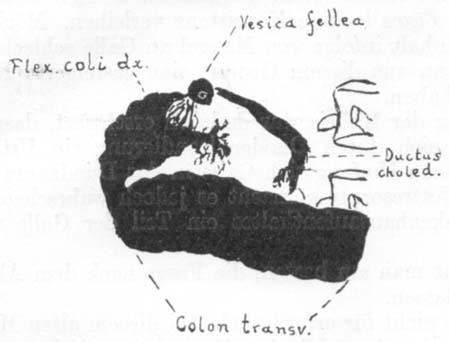 geschrzcmipfte GalZenblase nebst dem Cysticus und Choledochus (siehe fig. 1, Tabula I und Fig. 2). Um die topographischen Verhilltnisse naher festzustellen, gab man Pat.