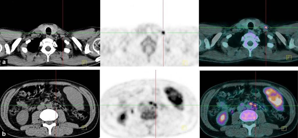 Sensitivität für + Lymphknoten bei Lymphomen: PET > CT Patient mit DLCBL: LK <