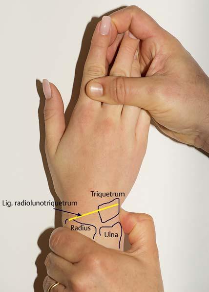 146 Untersuchung und MR-Morphologie des ulnokarpalen Handgelenkschmerzes Die Hand des Patienten steht in Pronation, der Untersucher fixiert mit einer Hand das Lunatum und löst mit der anderen