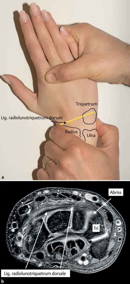 Lunotriquetral Shear Test Dieser von Kleinman [18] propagierte Test zum Nachweis einer Instabilität im LT-Gelenk kann mit einer Hand durchgeführt werden: Das Handgelenk steht in Abb.